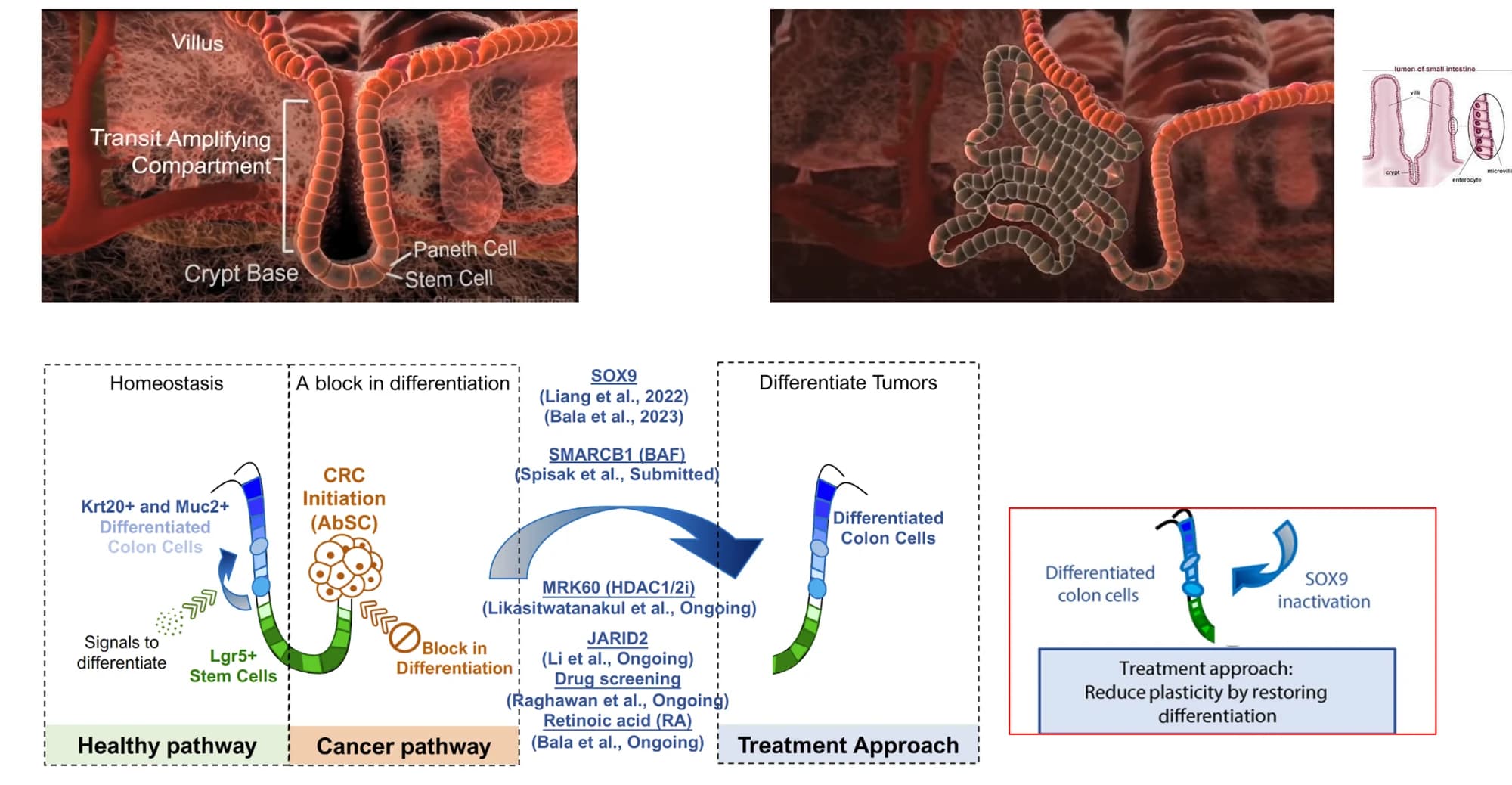 Three-panel figure. Healthy pathway: Lgr5+ stem cells differentiate via signals into Krt20+/Muc2+ differentiated colon cells. Cancer pathway: a block in differentiation traps aberrant stem cells (AbSC), initiating colorectal cancer. Treatment approach: restoring differentiation (via SOX9 inactivation, BAF/SMARCB1, HDAC1/2, JARID2, retinoic acid) reduces plasticity and shifts cancer cells back toward differentiated colon cells.